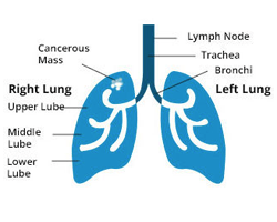 link between asbestos cancer and mesothelioma