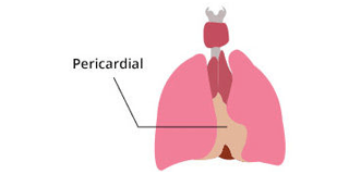 Pericardial Mesothelioma