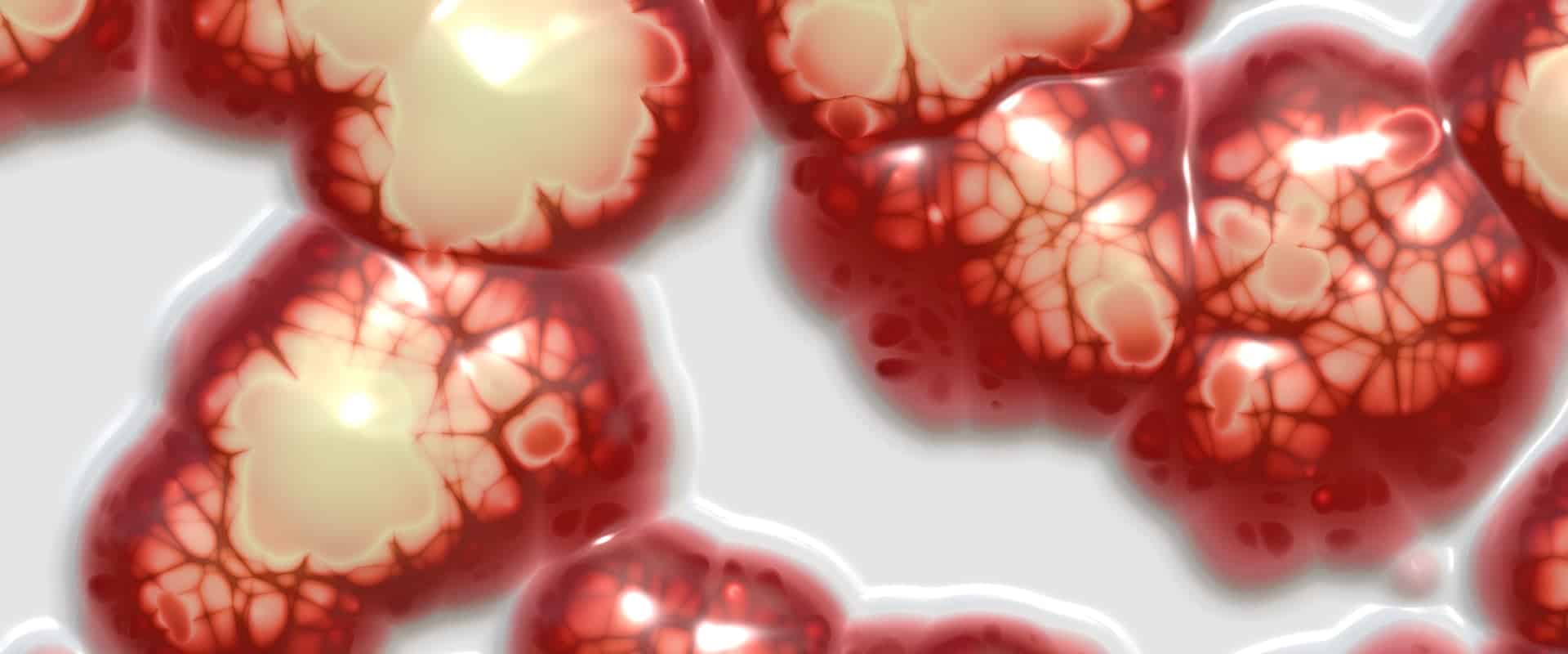 treatment of malignant pleural effusion