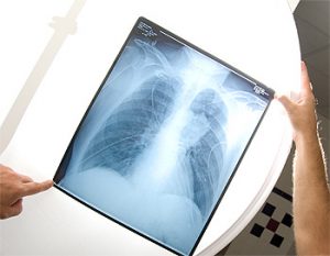 New Early Lung Cancer Test May Help Diagnose Malignant ...