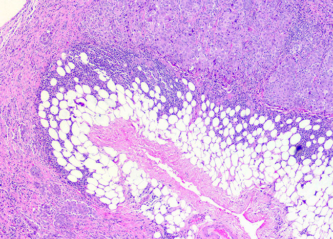 Epithelioid Mesothelioma | Epithelial Treatment and ...