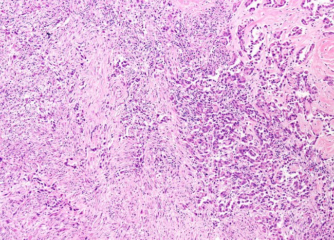 Biphasic Mesothelioma Cells