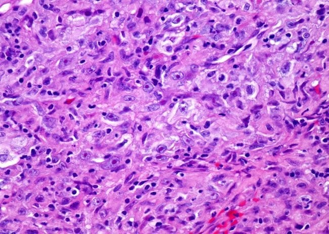 Sarcomatoid Mesothelioma Cells