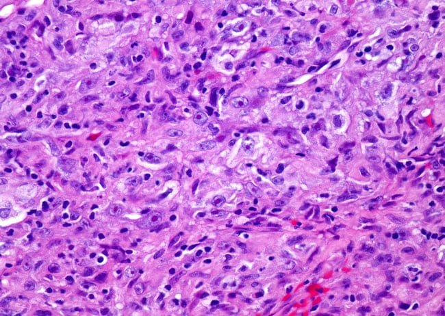 Sarcomatoid Mesothelioma Cells