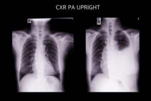 pleural effusion