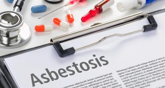 asbestosis