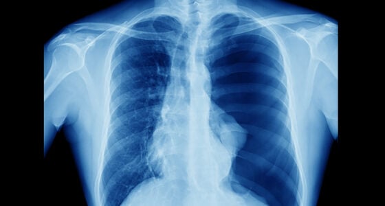 pneumothorax