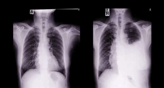 pleural effusion