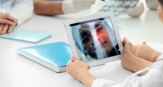 lung cancer